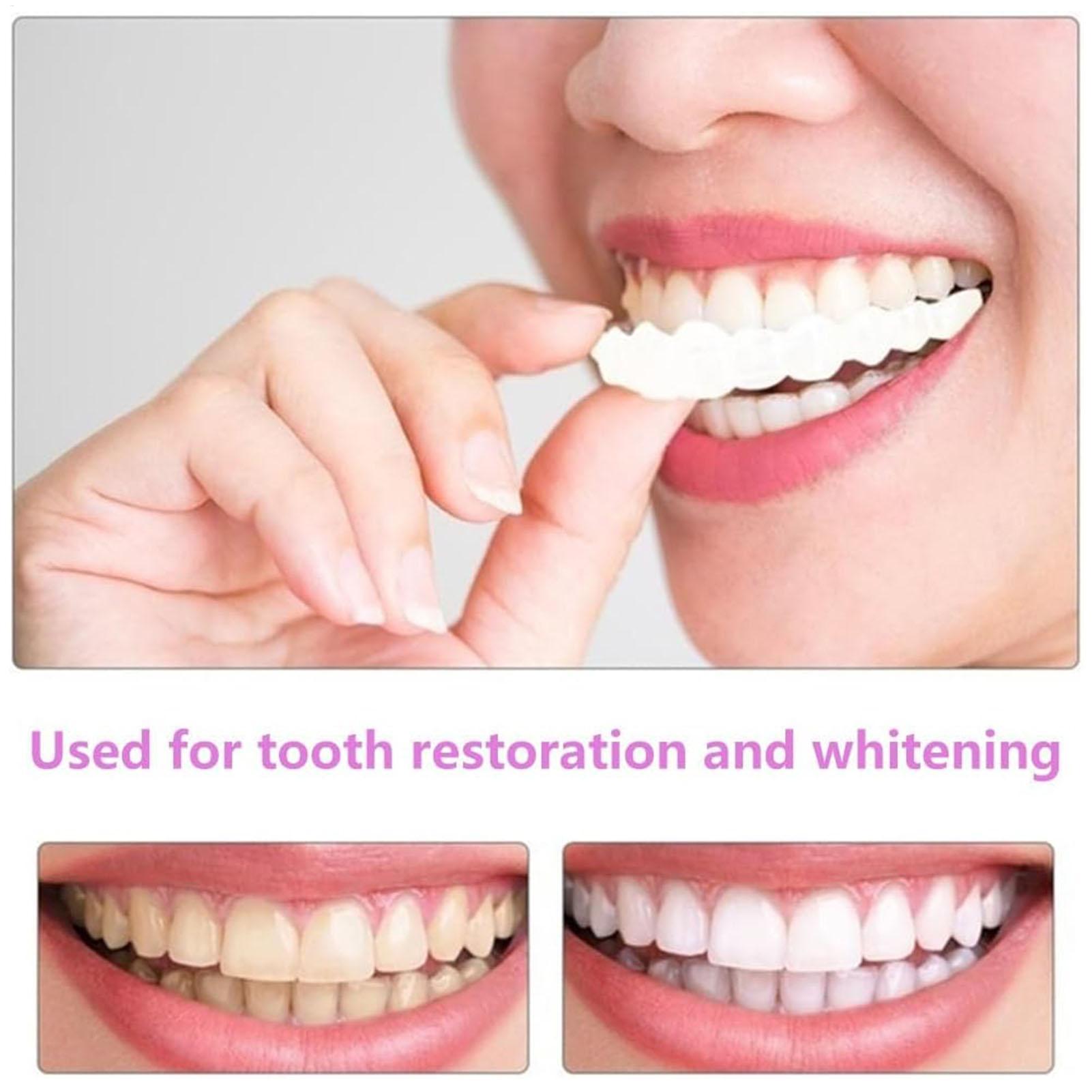 Diş Üst Alt Takma Diş Kaplamas - Teeth Whitening With Braces incelemesi ve fiyatı