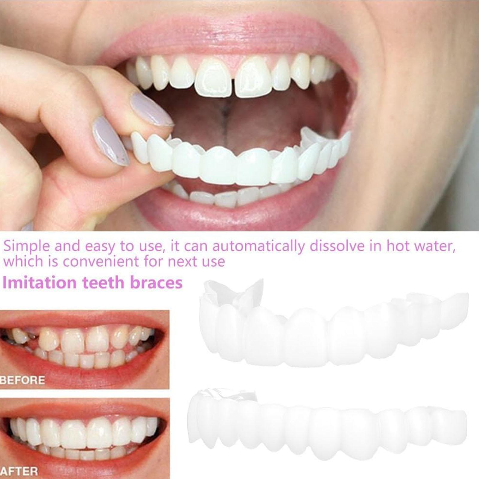 Diş Üst Alt Takma Diş Kaplamas - Teeth Whitening With Braces incelemesi ve fiyatı