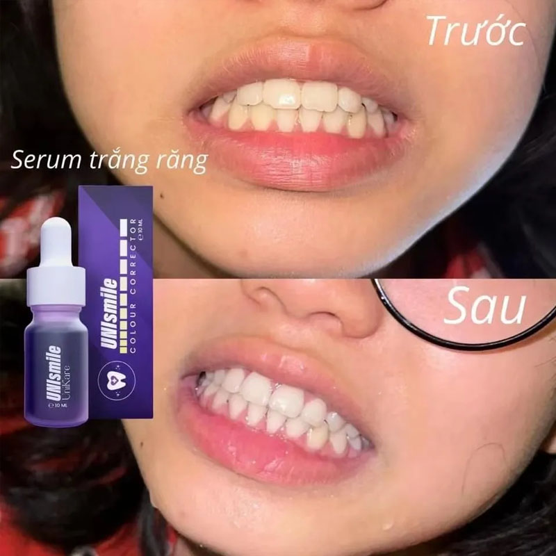 Unismile Diş Beyazlatıcı Esans - Teeth Whitening Effective incelemesi ve fiyatı