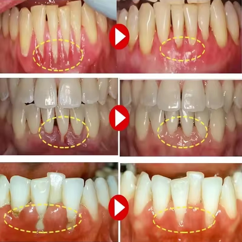 Diğer adımlar: Diş Beyazlatma  - Teeth Whitening Gels incelemesi ve fiyatı