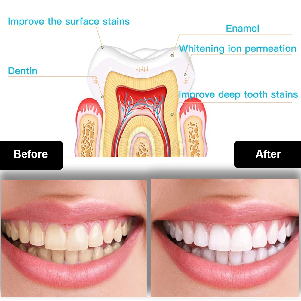 Diş Diş Beyazlatma Kiti Mini 1 - Teeth Whitening Led Kit incelemesi ve fiyatı