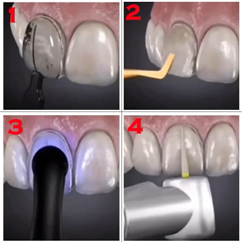 Kompozit Reçine Kaplamaları İç - Teeth Whitening Moulds incelemesi ve fiyatı