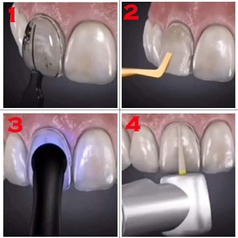 32 adet Diş Kaplama Kalıp Seti - Teeth Whitening Moulds incelemesi ve fiyatı
